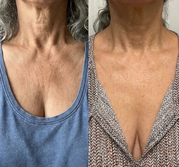 Meredith A., 54 before and after