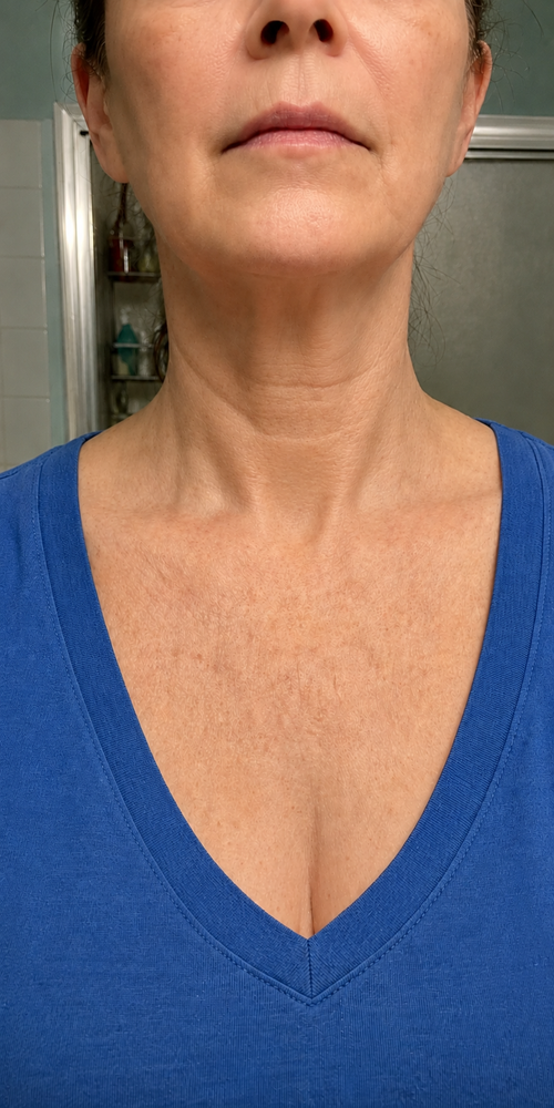Décolleté · 10 weeks after