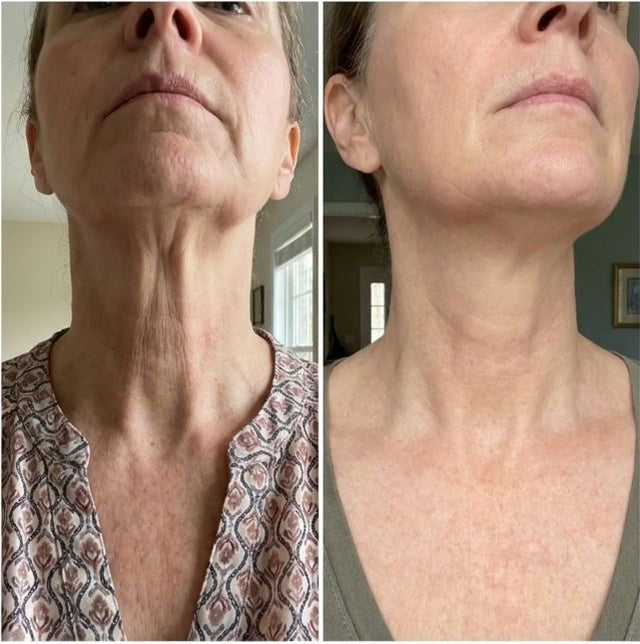 Eleanor R., 56 before and after