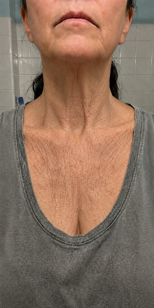 Décolleté · 10 weeks before
