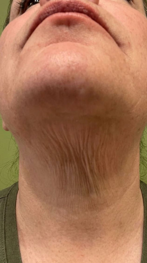 Neck & jawline · 12 weeks before