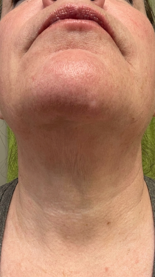 Neck & jawline · 12 weeks after